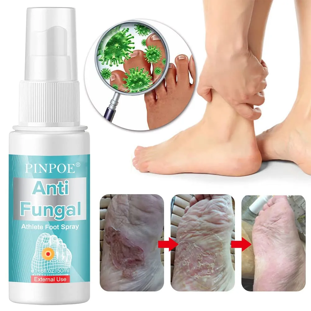 Antifungal Foot Spray, Athlete's Foot Spray Liquid, Athletes Foot Spray, Antifungal Deodorant, Anti-Fungi Treatment of Athletes Foot and Ringworm, Prevents Reinfection Soothe Itching Blue